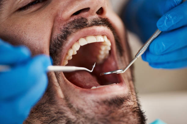 Best Broken or Cracked Tooth Emergency Dentist in Coeur Dalene, ID